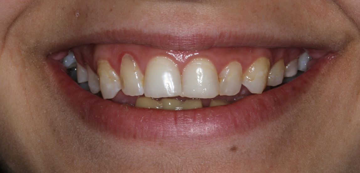 Upper and lower stained, crooked teeth, gummy smile porcelain veneers treatment