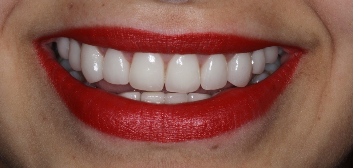 Natural Porcelain Veneers Sydney smile makeover