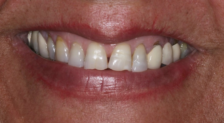 Teeth to be repaired by Cosmetic Dentist Sydney