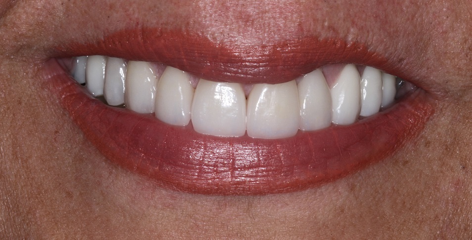 Smile Makeover, Cosmetic Dentist Sydney