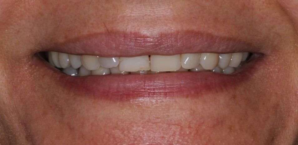 Short teeth stained treatment with porcelain veneers in sydney