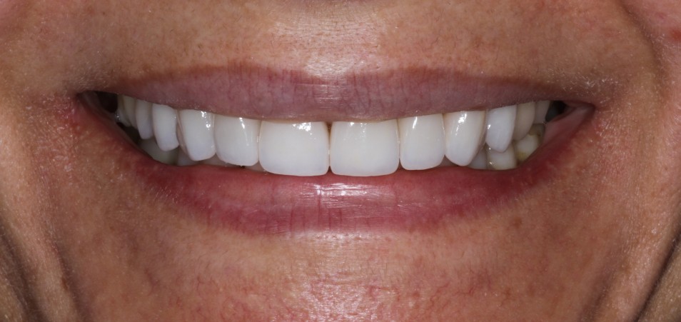 Porcelain Veneers Sydney affordable cost