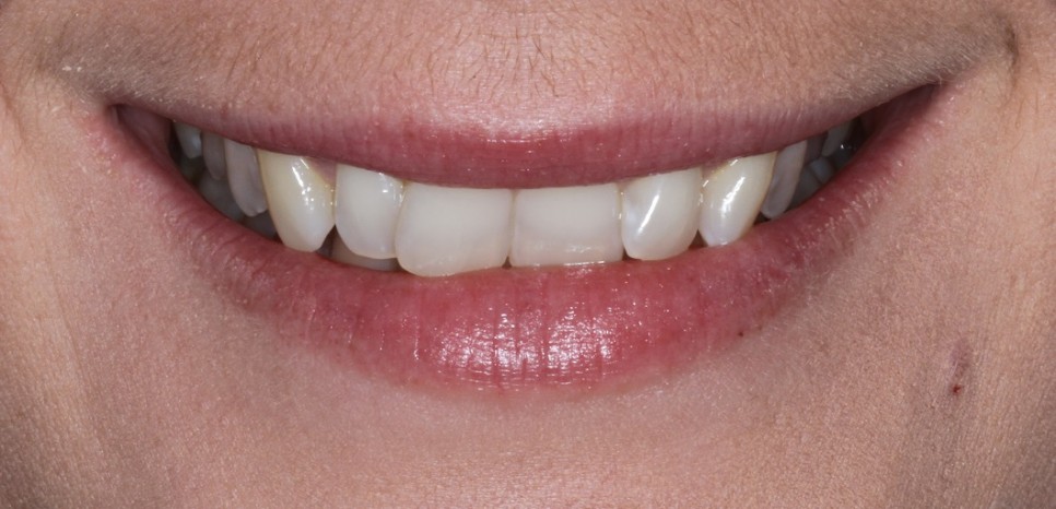 cosmetic Dentistry Veneers for crooked teeth in sydney