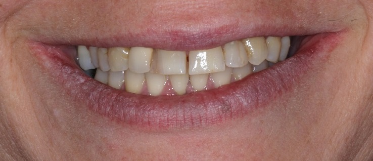 Before Dental Veneers Sydney