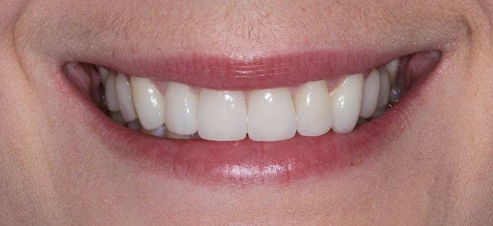 Dental Veneers broad smile