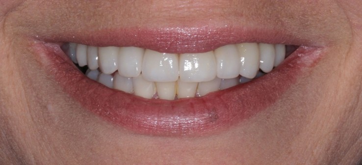 Teeth Veneers Sydney