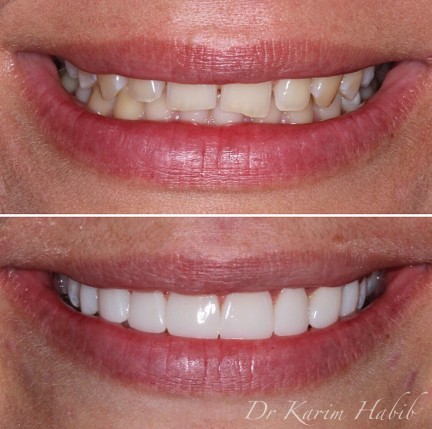 Best Cosmetic Dentistry Sydney Composite Veneers 