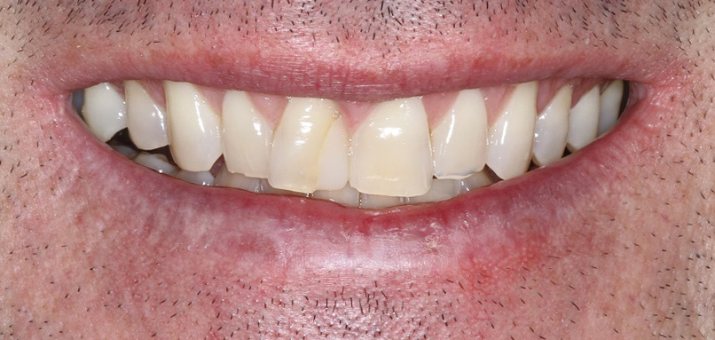 Veneers for yellow teeth Sydney