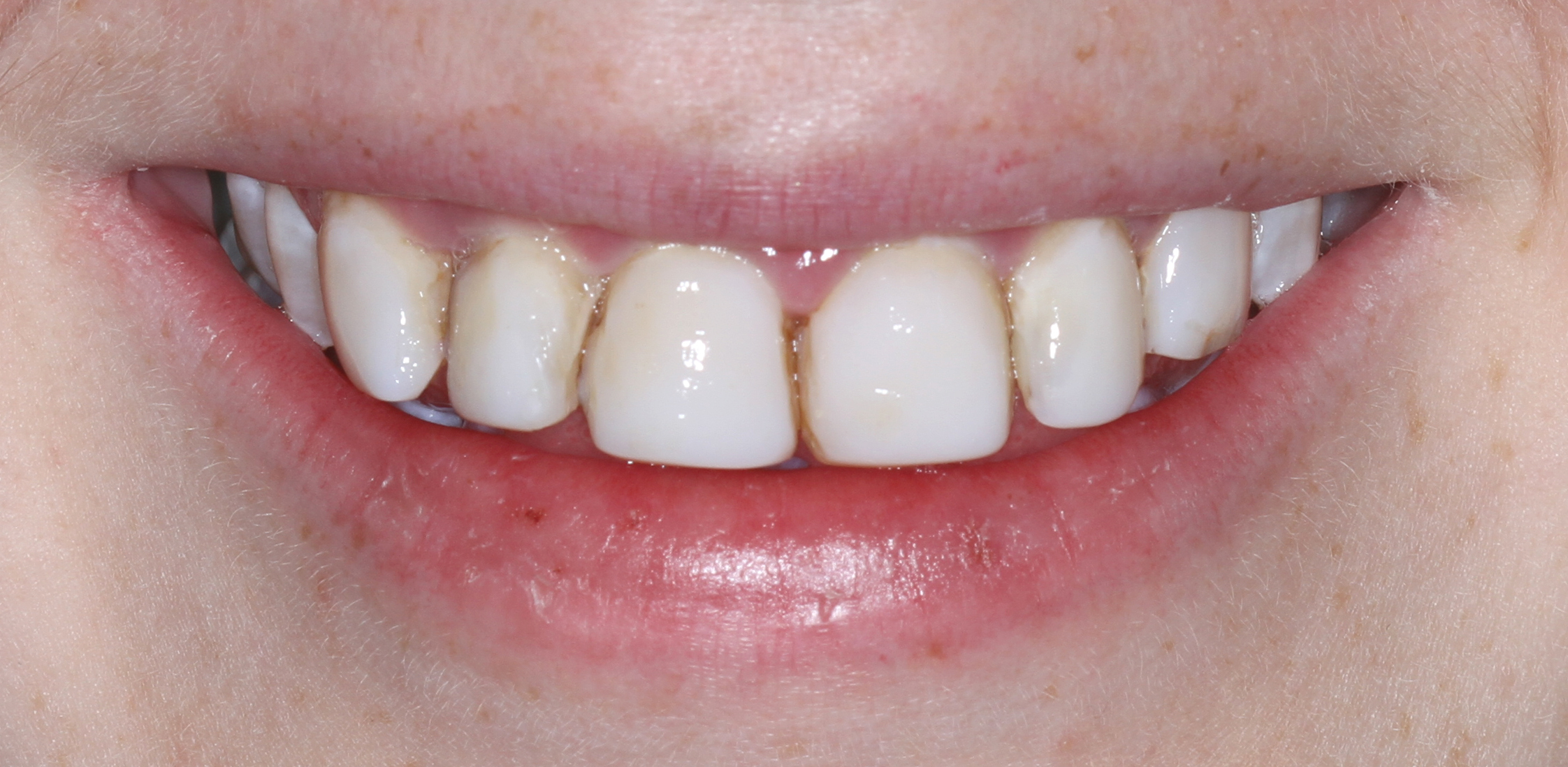 Before treatment by Sydney Cosmetic Dentist