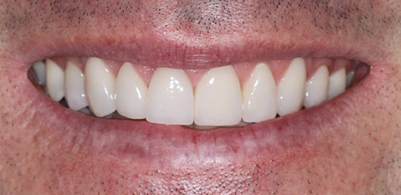 Natural Porcelain veneers in Sydney