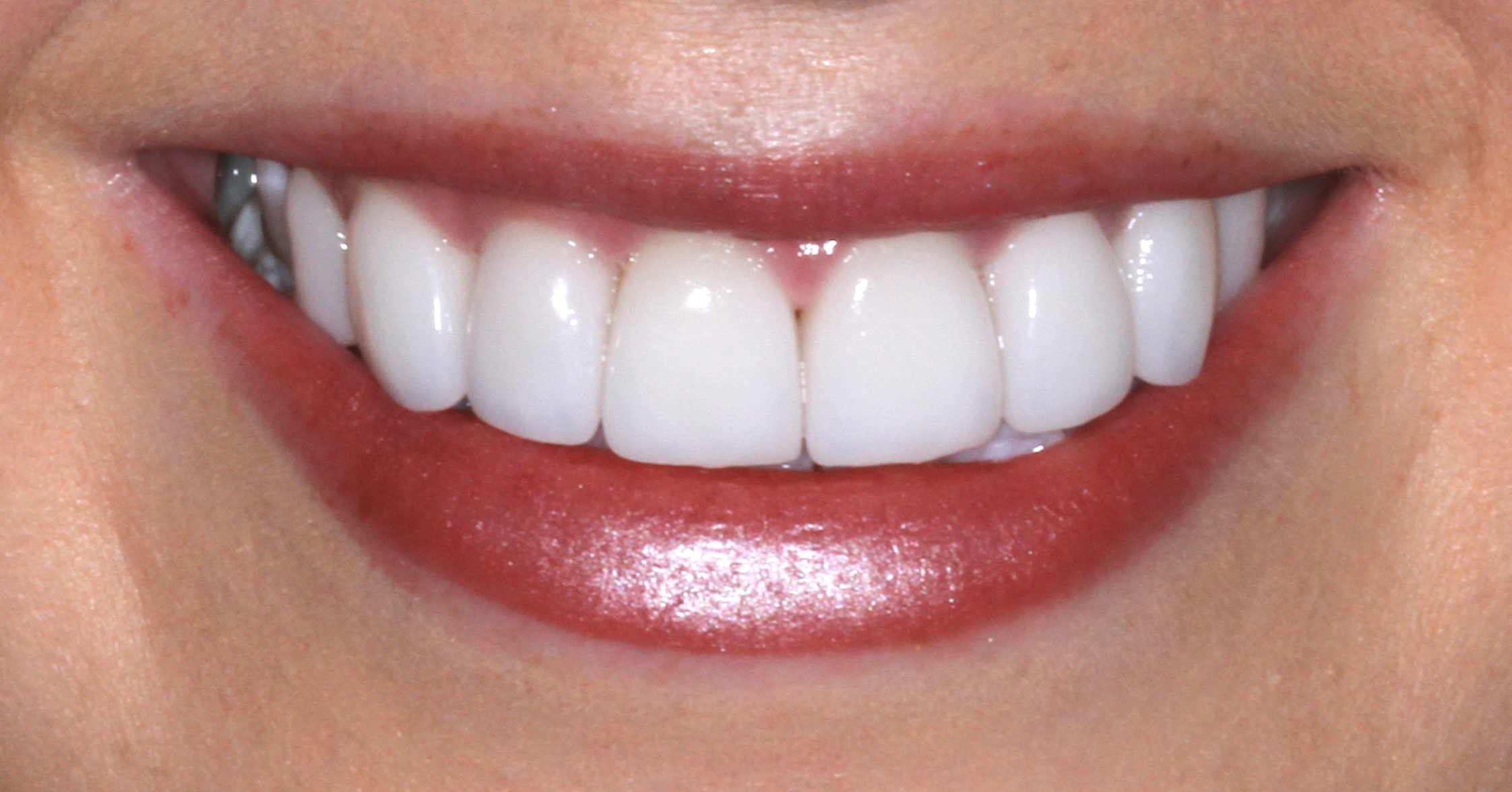 Sydney Smile Makeover