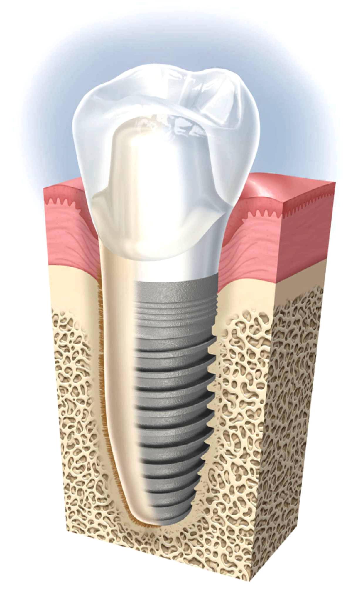 dental implants ryde cost