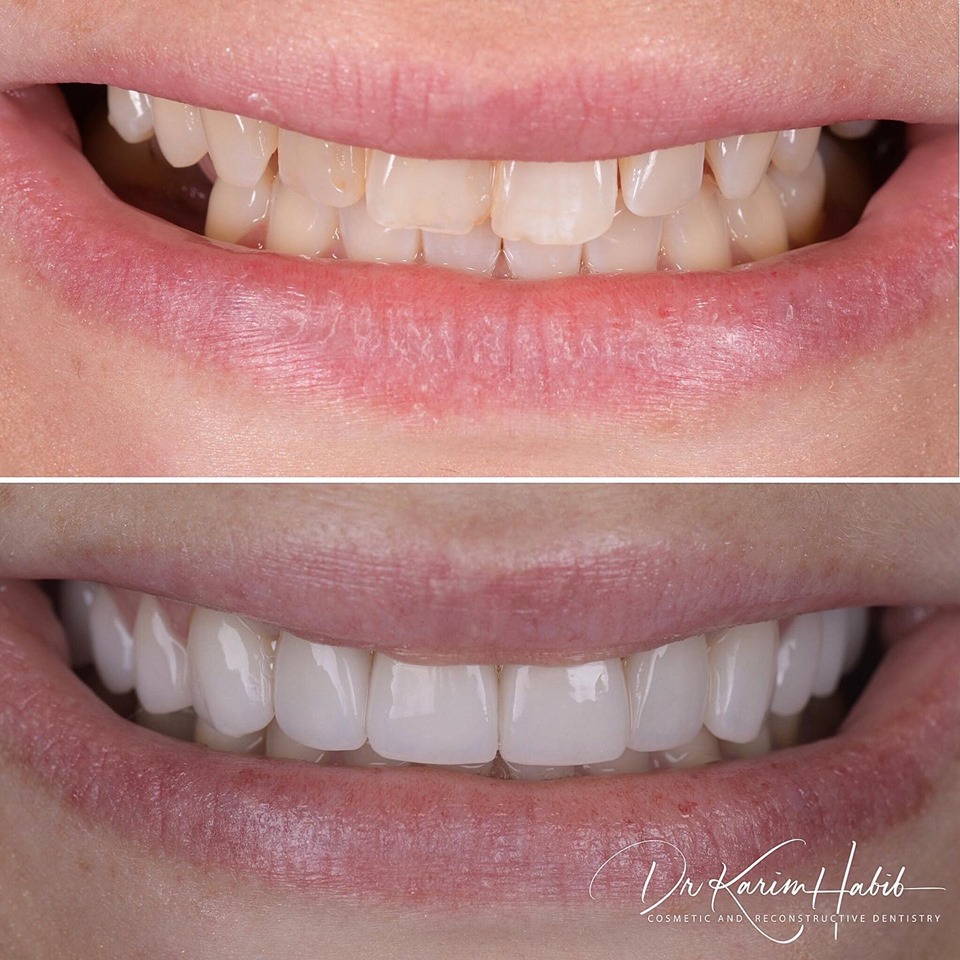 Porcelain Veneers Sydney