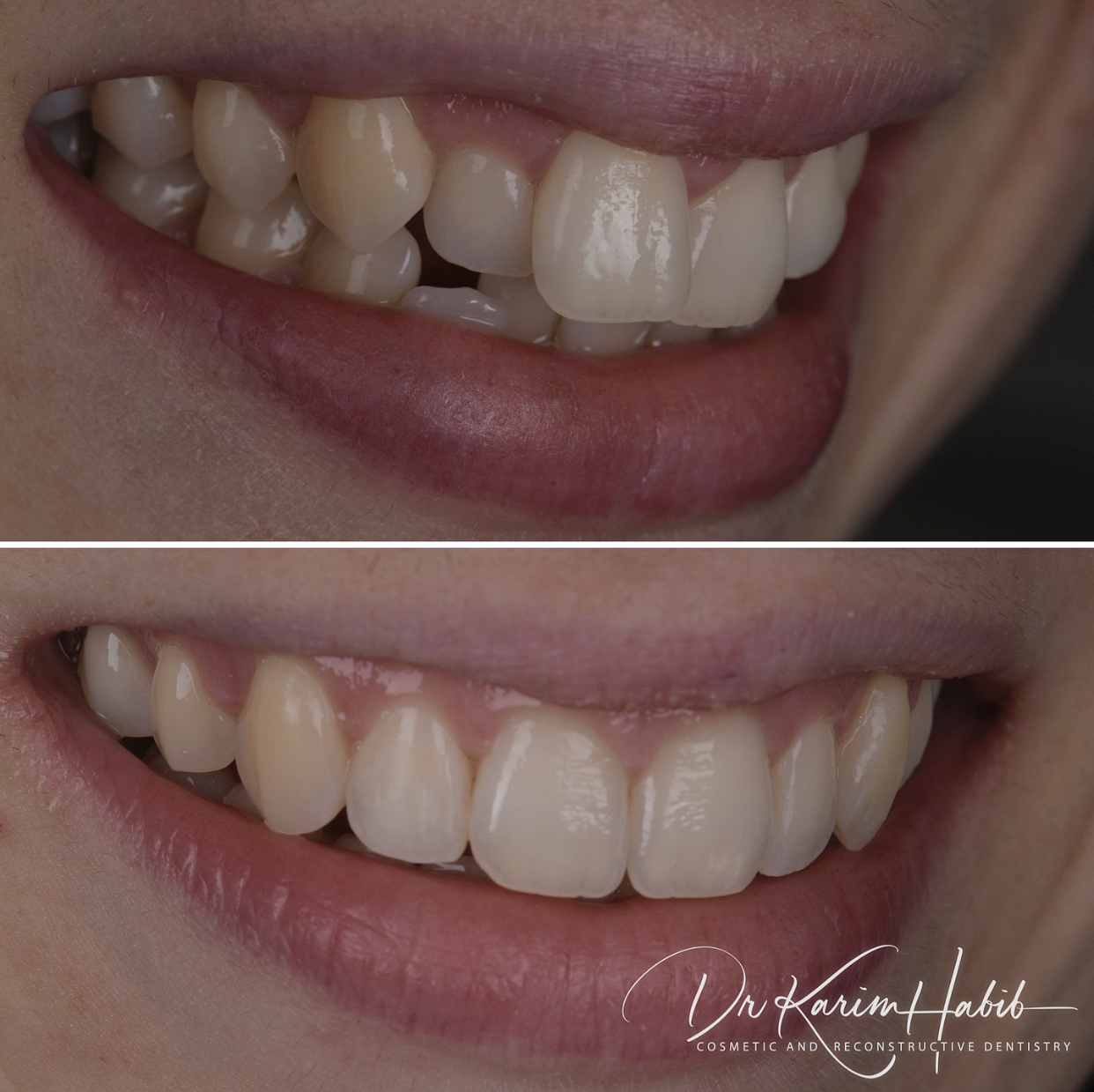 Cosmetic Dentistry invisalign