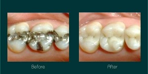 white fillings dentist ryde