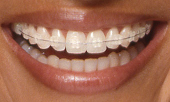 clear tooth coloured braces orthodontist