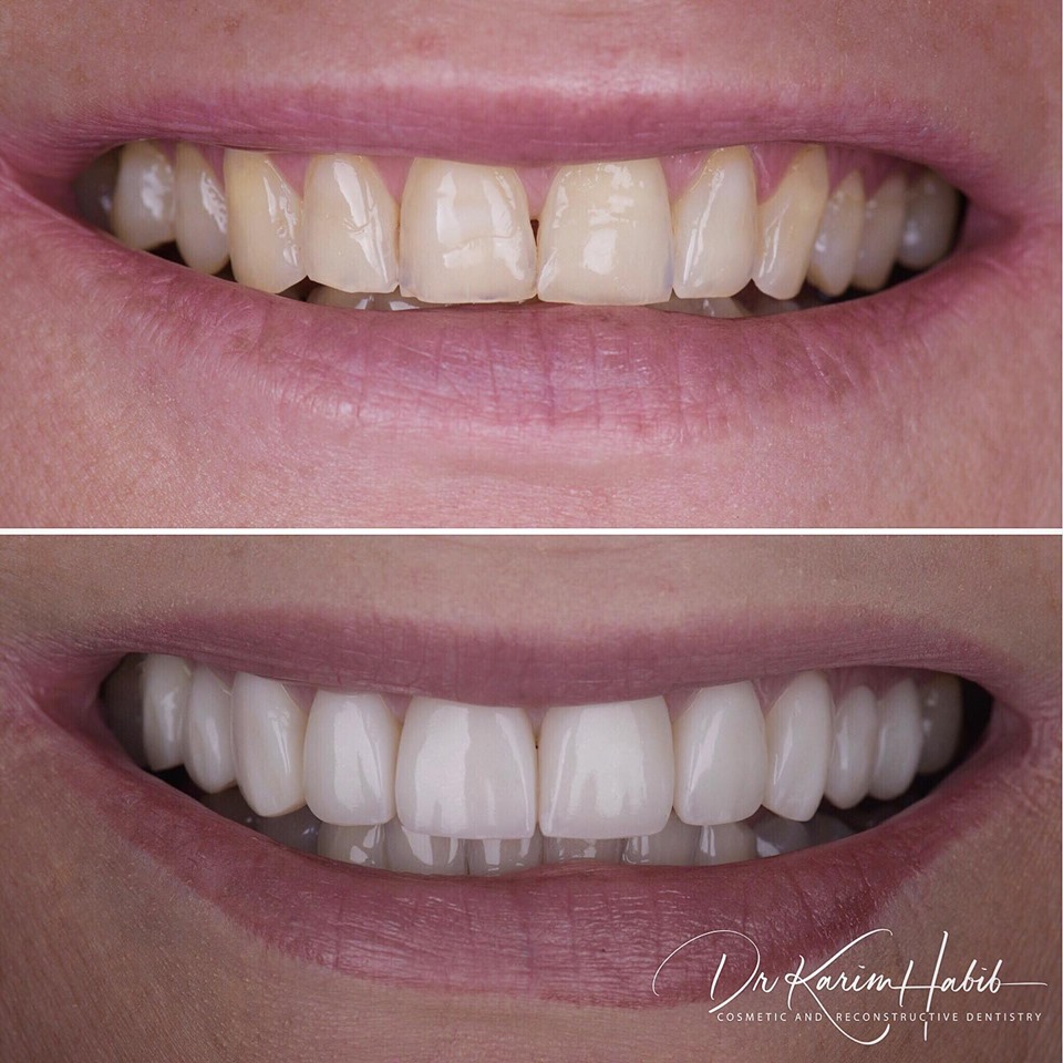 composite veneers sydney