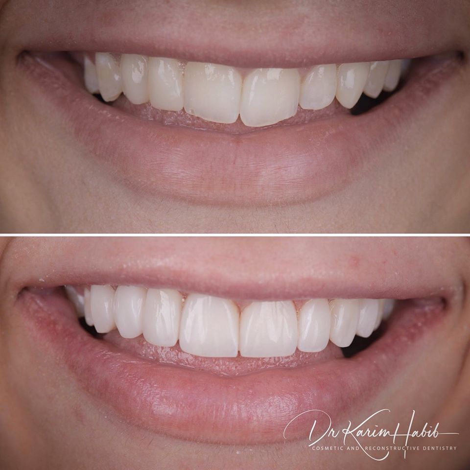 australia composite veneers