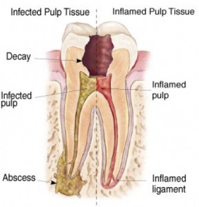 dental caries