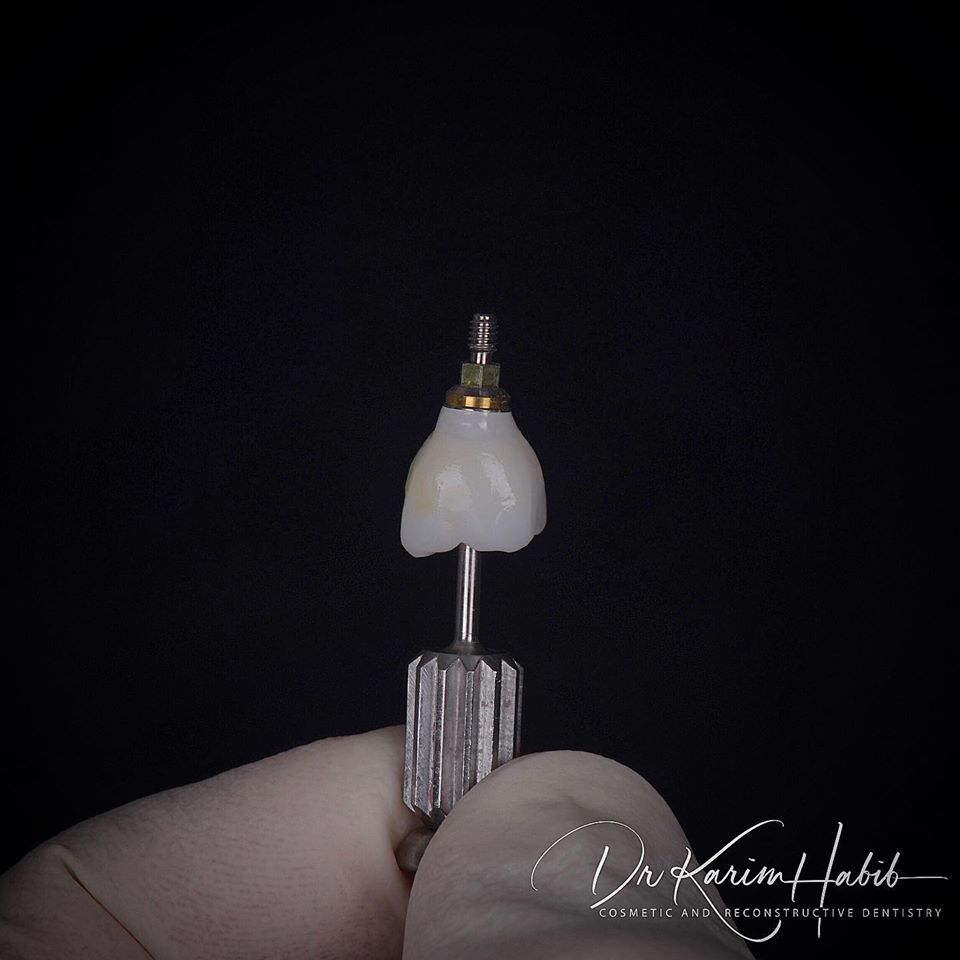 dental-implants-sydney