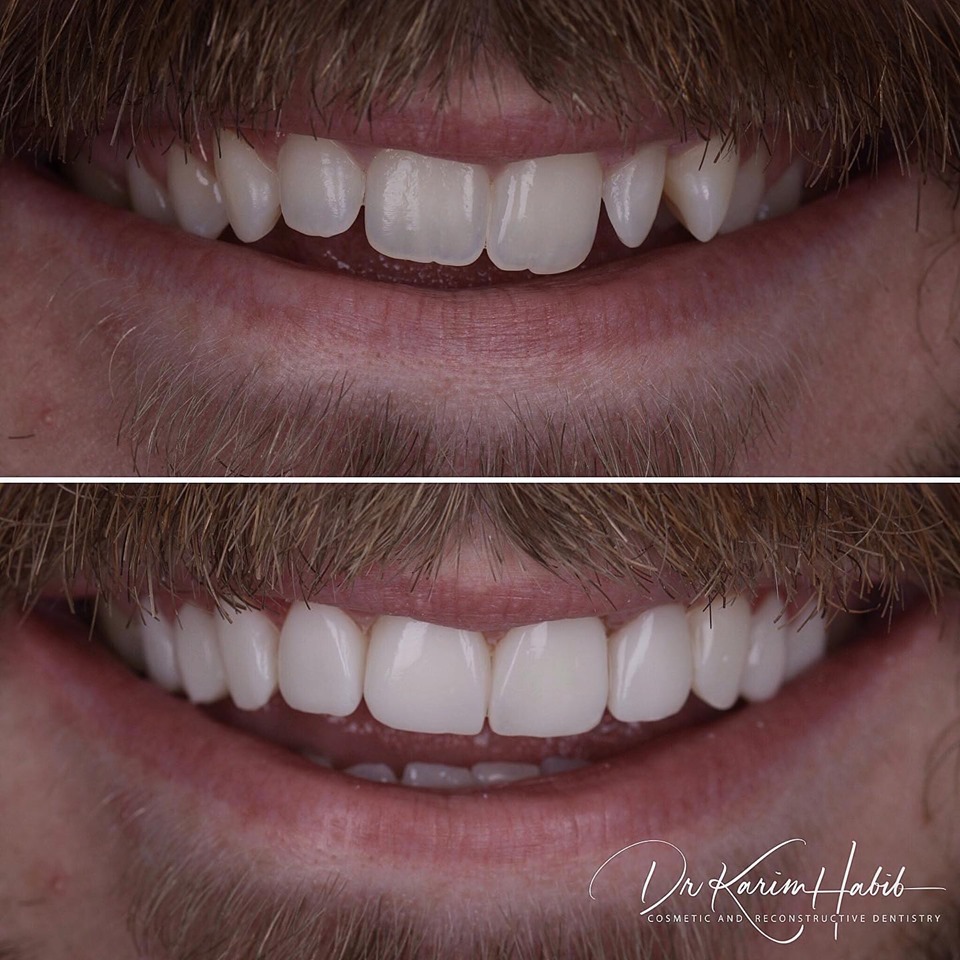 direct veneers sydney