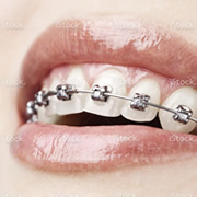 Orthodontist Ryde braces
