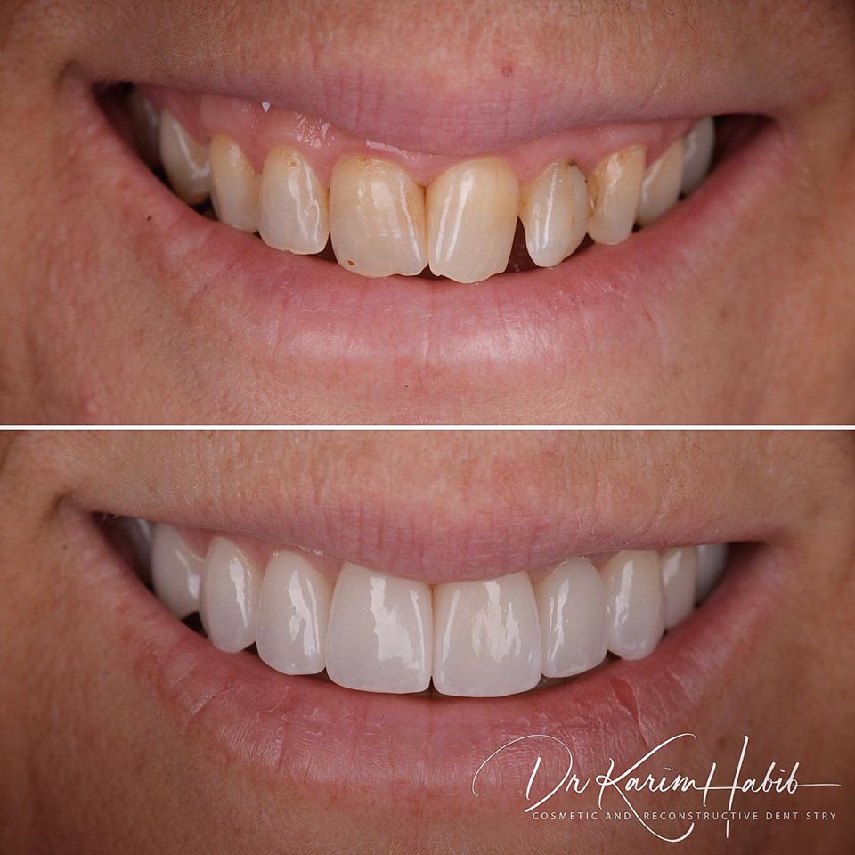 Porcelain Veneers Sydney