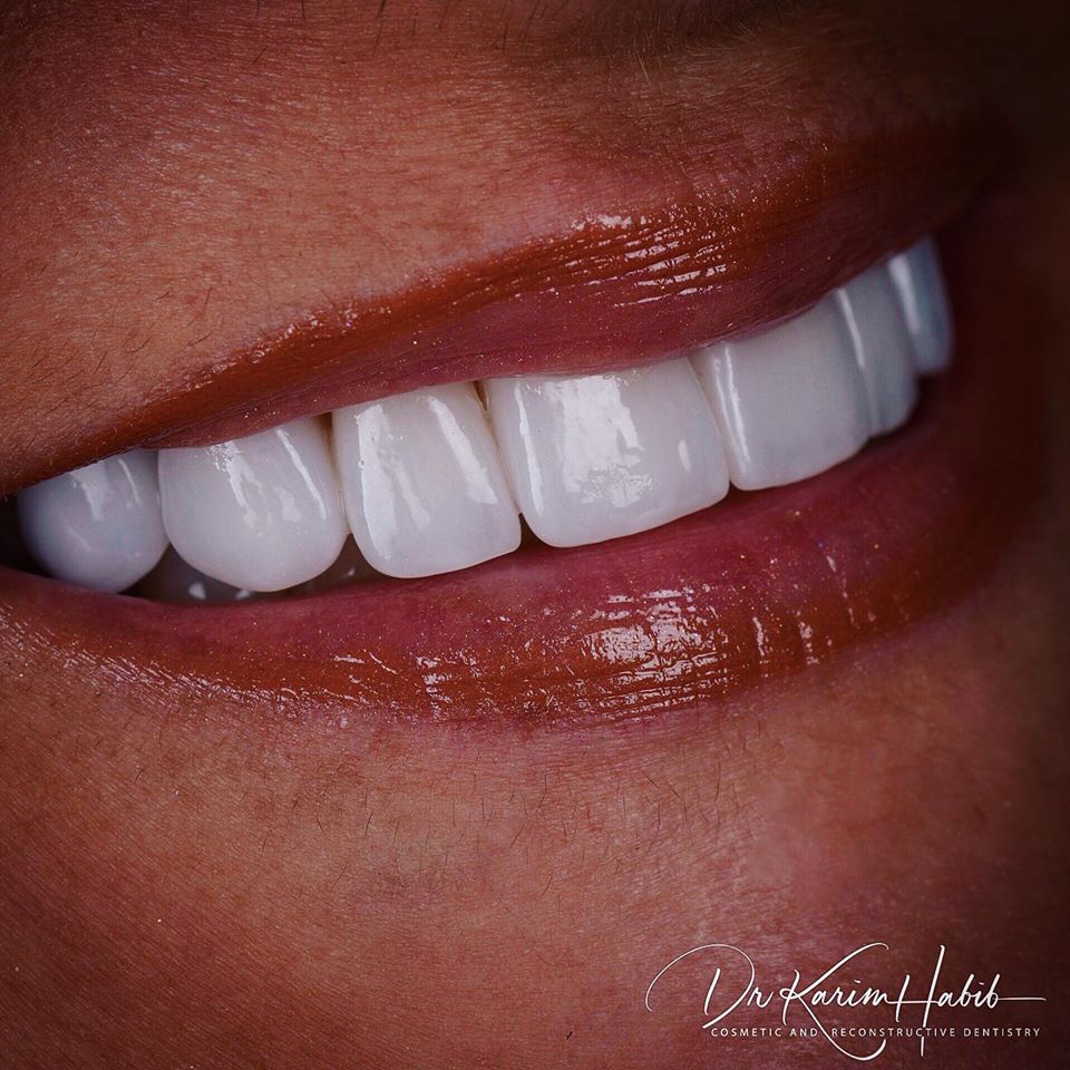 Porcelain Veneers Sydney - unrivalled quality