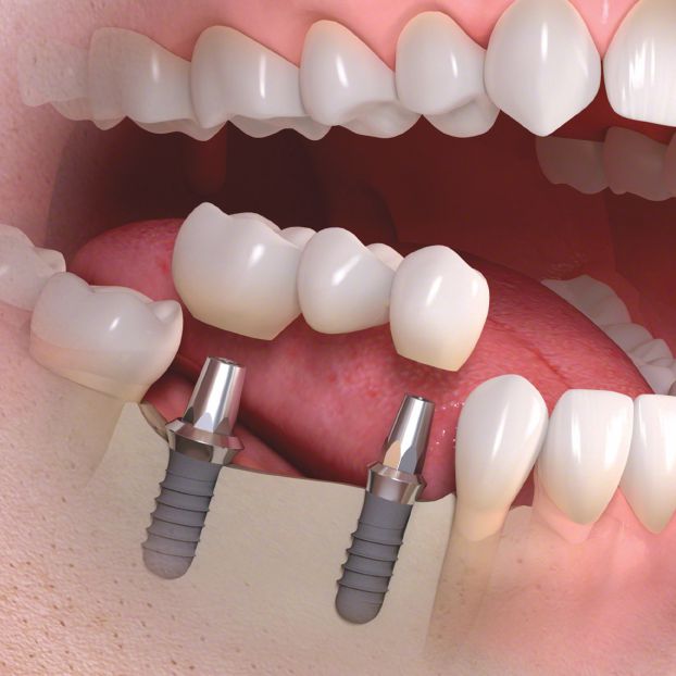 implant bridge