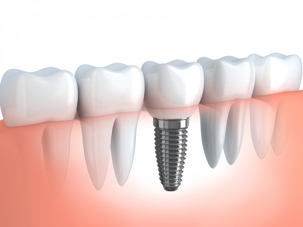 dental implant cost