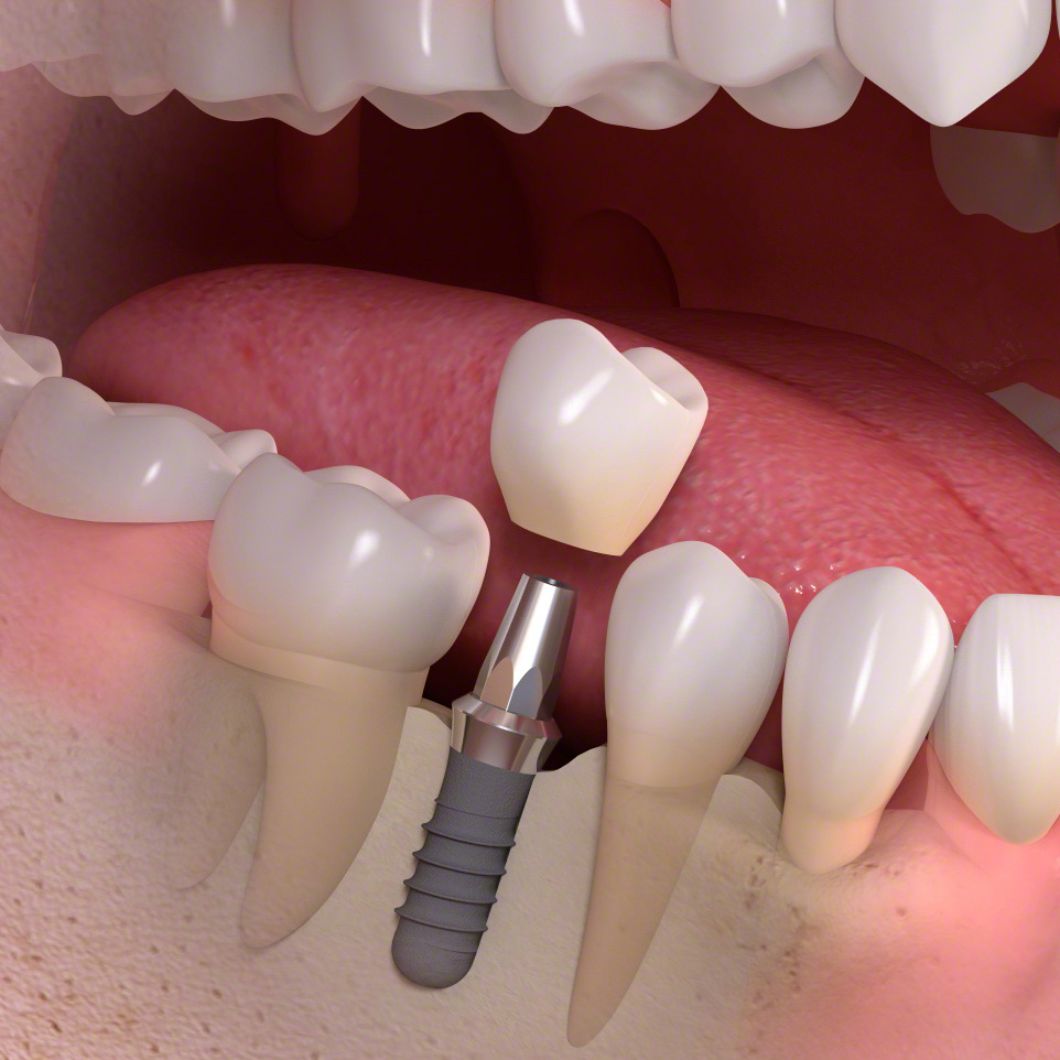 single tooth implant ryde