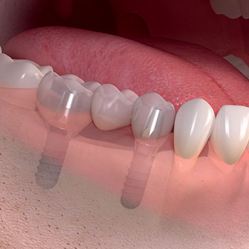Implant for gap 
