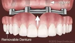 implant overdenture