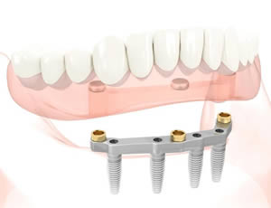 implant supported overdenture