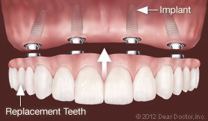implant-supported-dentures-300x175