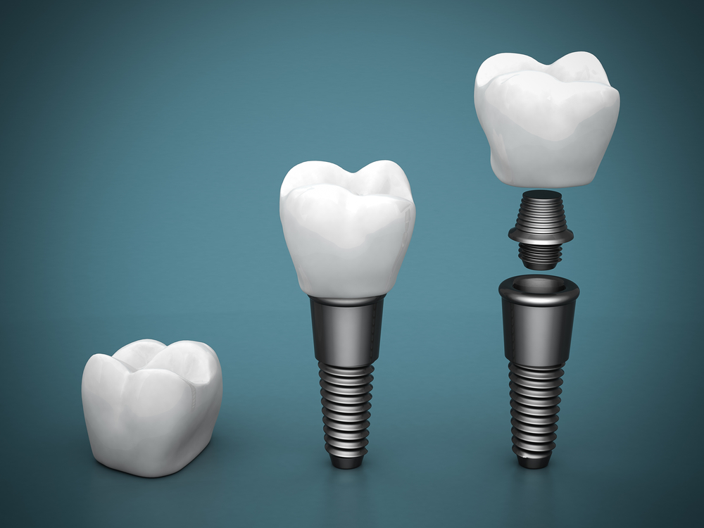 The components of a dental implant