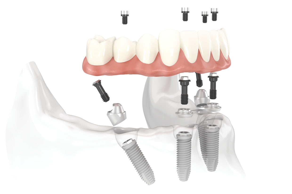 Dentistrydeimplants