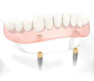 Implant denture