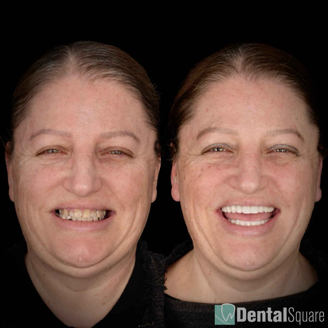 All teeth on 4 implants - upper and lower full arch implants