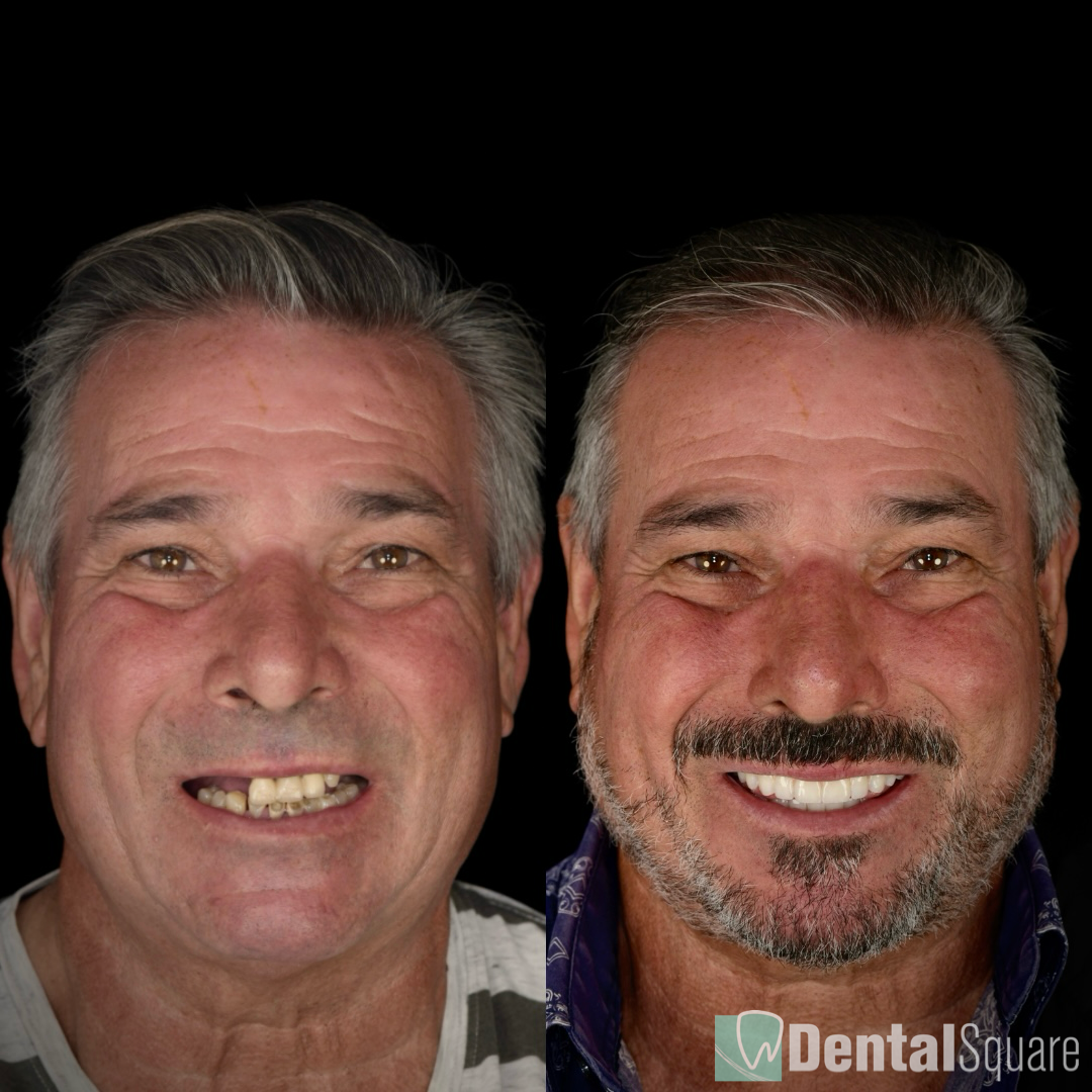 Sydney All on 4 Dentist - All on X