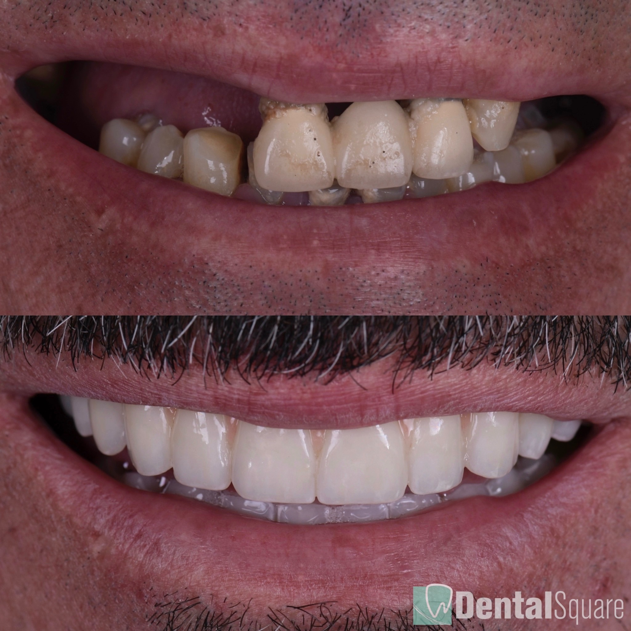 teeth in a day sydney all on 4